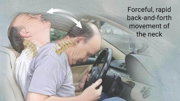 Car hotsell head restraint